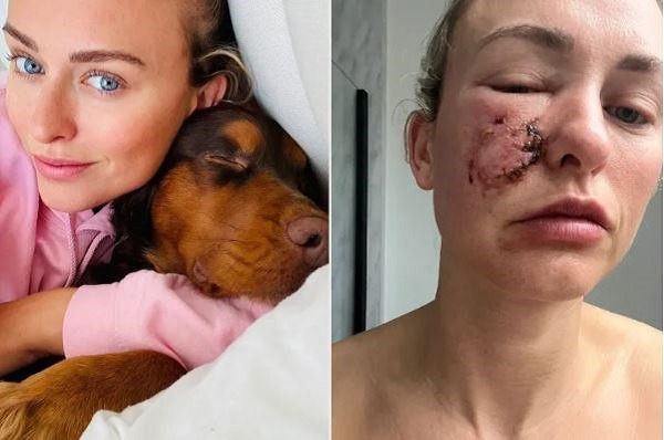 Colaj foto cu o femeie mușcată de câine